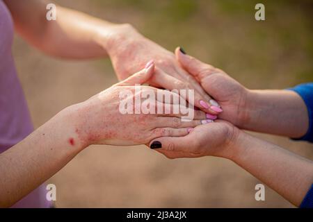 Primo piano dermatite sulla pelle, il male allergico rash eczema pelle del paziente, dermatite atopica sintomo pelle dettaglio texture, Fungus della pelle, il concetto de Foto Stock