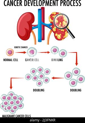 Diagramma che mostra l'illustrazione del processo di sviluppo del cancro Illustrazione Vettoriale