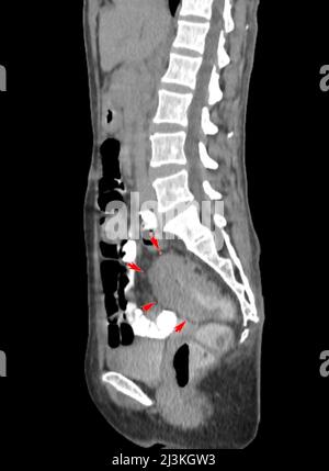 Cancro rettale, scansione TC Foto Stock