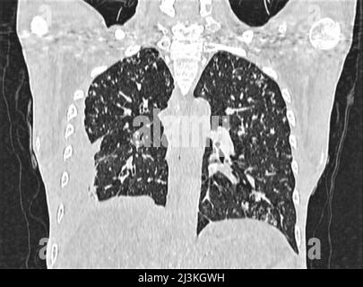 Tubercolosi miliare, TAC toracica Foto Stock