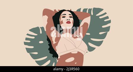 Giovane donna con vitiligo. Illustrazione vettoriale positiva del corpo alla moda. Concetto di giorno di vitiligo di mondo. Illustrazione Vettoriale