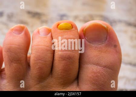 Primo piano di unghie della punta con un fungo infetto unghie, malattia comune e infezioni Foto Stock