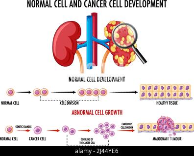 Diagramma che mostra l'illustrazione del processo di sviluppo del cancro Illustrazione Vettoriale