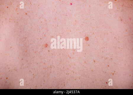 Moli sulla pelle Foto Stock