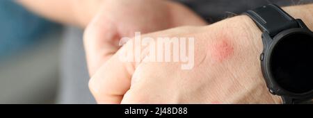 Primo piano di macchia rossa sulla pelle della mano dell'uomo Foto Stock