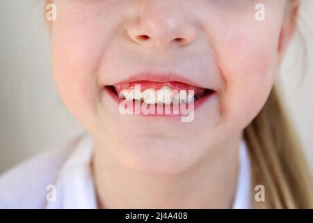 Il bambino ha denti storto. Il concetto di coronamento di molari. Foto Stock