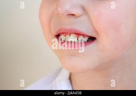 Il bambino ha denti storto. Il concetto di coronamento di molari. Foto Stock