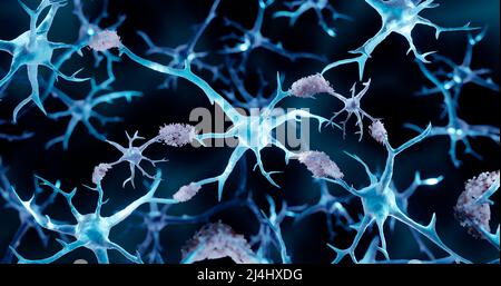 Malattia di Alzheimer, illustrazione Foto Stock