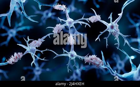 Placche amiloidi, illustrazione Foto Stock