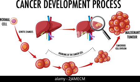 Diagramma che mostra l'illustrazione del processo di sviluppo del cancro Illustrazione Vettoriale