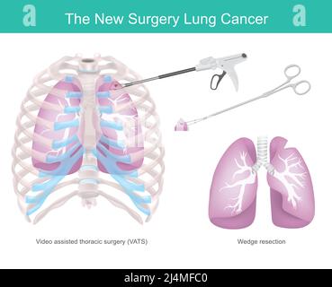 Tecnica chirurgica per il cancro polmonare. Tecnica chirurgica che rimuove una parte del polmone a causa del cancro. Illustrazione Vettoriale