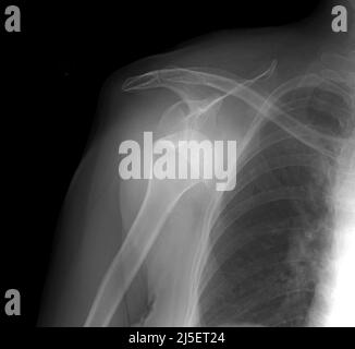 Spalla destra sposizionata, raggi X. Foto Stock