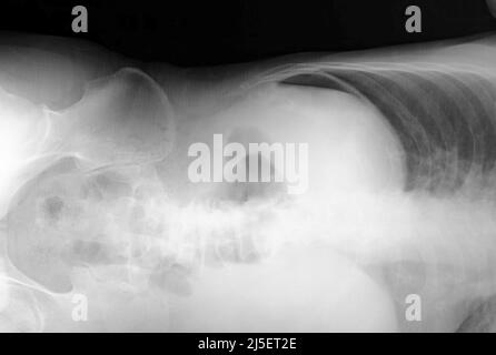 Pneumoperitoneum, raggi X. Foto Stock