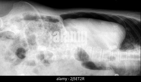 Pneumoperitoneum, raggi X. Foto Stock