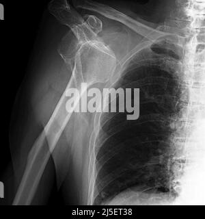 Spalla destra sposizionata, raggi X. Foto Stock