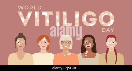 Giornata mondiale della vitiligine banner del 25 giugno. Facce femminili con etnici differenti, colori della pelle, acconciature con malattia della pelle di vitiligo. Concetto di corpo positivo. FLA Illustrazione Vettoriale