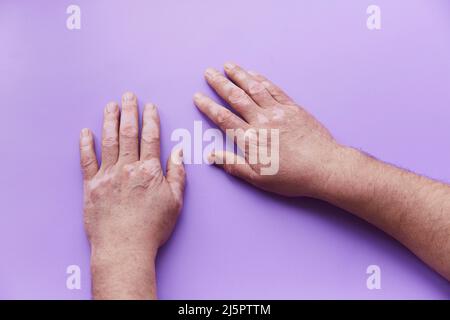 Mostrare il problema vitiligine mani su sfondo viola. Problema di pigmentazione cutanea. Foto di alta qualità Foto Stock