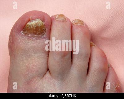 Infezione fungina da unghia, Onicomicosi, Stock Photo of Yellow Nails toenails spesse, infette, unghie fragili, Fungo, piedi caucasici Foto Stock