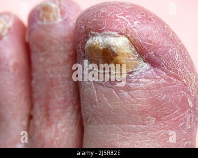 Infezione fungina da unghia, Onicomicosi, Stock Photo of Yellow Nails toenails spesse, infette, unghie fragili, Fungo, piedi caucasici Foto Stock