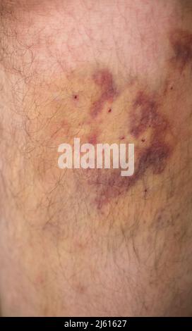 Ematoma grande sulla gamba dopo iniezioni per un intervento medico. Foto Stock