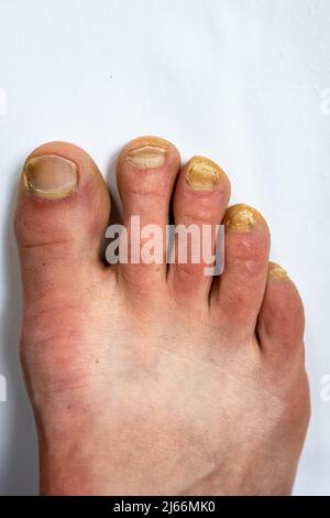 Piede dell'uomo adulto con l'infezione fungina del chiodo. Foto Stock