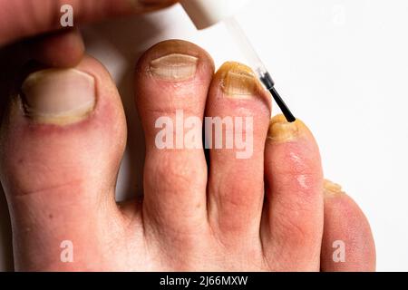Utilizzando una vernice contro il fungo dell'unghia. Trattamento delle infezioni fungine delle unghie. Foto Stock