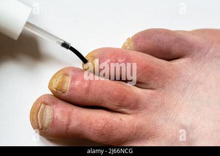 Utilizzando una vernice contro il fungo dell'unghia. Trattamento delle infezioni fungine delle unghie. Foto Stock