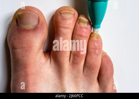 Usando una penna contro il fungo del chiodo. Trattamento delle infezioni fungine delle unghie. Foto Stock