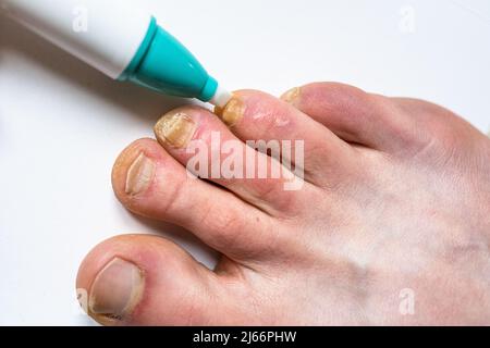 Usando una penna contro il fungo del chiodo. Trattamento delle infezioni fungine delle unghie. Foto Stock