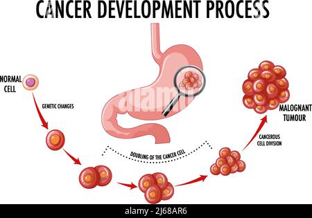 Diagramma che mostra l'illustrazione del processo di sviluppo del cancro Illustrazione Vettoriale