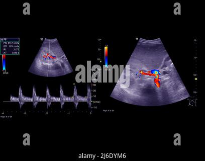 Ecografia della parte superiore dell'addome che mostra il flusso nel dotto biliare comune dopo l'uso Doppler a colori. Foto Stock