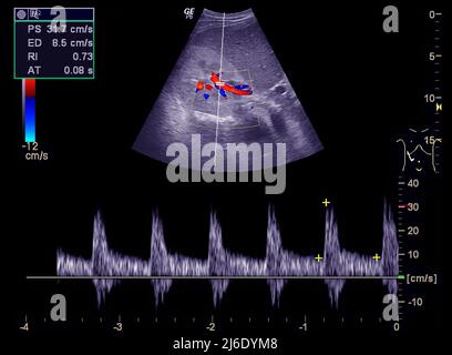 Ecografia della parte superiore dell'addome che mostra il flusso nel dotto biliare comune dopo l'uso Doppler a colori. Foto Stock