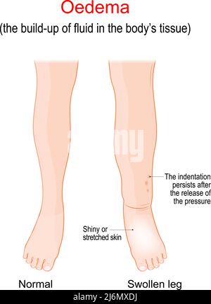 Edema. Gonfiore delle caviglie, dei piedi e delle gambe. L'edema è l'accumulo di liquido nel tessuto corporeo. Illustrazione vettoriale. Poster per uso medico Illustrazione Vettoriale