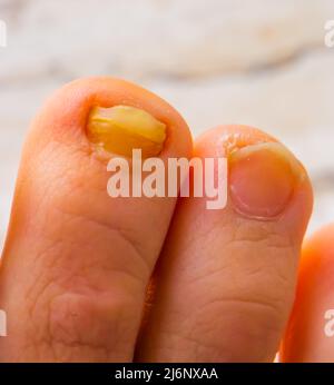 primo piano di un fungo infetto unghia del piede accanto a uno healty, infezioni comuni e malattia Foto Stock