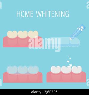 Il concetto di denti domestici che sbiancano dal giallo al bianco. Fasi consecutive di candeggio con gel e protezione del boccaglio a casa.prima e dopo. Moderno com Illustrazione Vettoriale