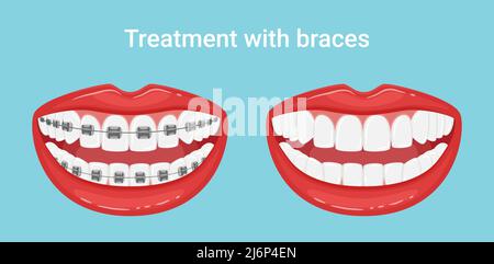 Denti in bocca con o senza bretelle. Durante e dopo il trattamento ortodontico. L'allineamento dei denti. Stile di vita sano e cura dentale. Whit Illustrazione Vettoriale