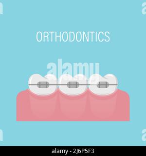 Allineamento dei denti con i rinforzi. Poster con denti in bretelle. Denti semplici bianchi sani di fila. Trattamento ortodontico. Illustrazione vettoriale isolata. Illustrazione Vettoriale
