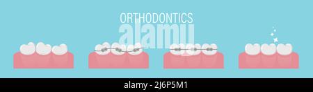 Il concetto di allineamento dei denti con i rinforzi. Poster con denti storto, in bretelle e sano anche. Denti semplici in fila. Trattamento ortodontico. Isola Illustrazione Vettoriale