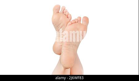 pelle ruvida su suole di piedi. tacchi asciutti, pelle screpolata asciutta sui piedi che richiede cura. Suole di piedi asciutte e screpolate. Gambe femminili in posizione elegante iso Foto Stock