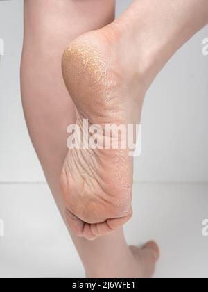 Primo piano della pelle asciutta dei piedi, suola con scaglie e crepe. Le gambe femminili, i piedi con pelle asciutta su tacchi e suole hanno bisogno di cura nel salone di bellezza spa. Incrinature o Foto Stock