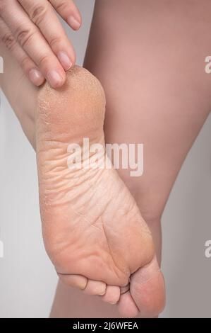 Donna toccare secco cracking pelle dei suoi piedi. Moisturizer e trattamento cosmetico sulle dita dei piedi e del tallone, Skinccare cosmetic. Primo piano di crepe sui tacchi con b Foto Stock