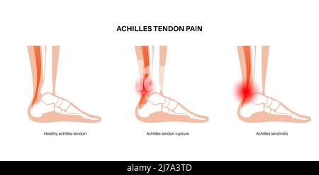 Lesione da tendine di Achilles, illustrazione Foto Stock