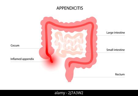 Infiammato appendice, illustrazione concettuale Foto Stock