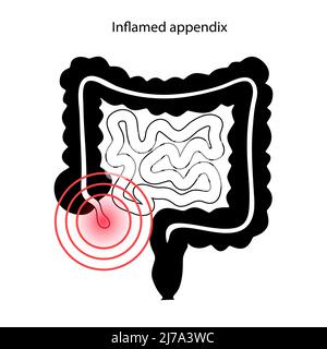 Infiammato appendice, illustrazione concettuale Foto Stock