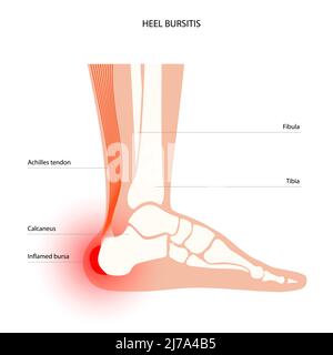Borsite del tallone, illustrazione concettuale Foto Stock