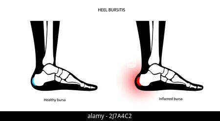 Borsite del tallone, illustrazione concettuale Foto Stock