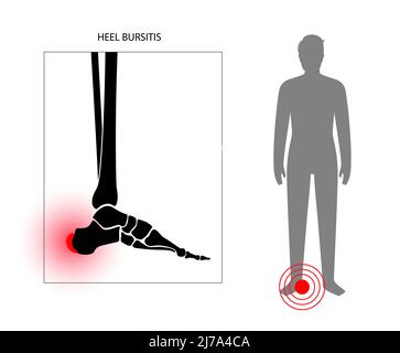 Borsite del tallone, illustrazione concettuale Foto Stock