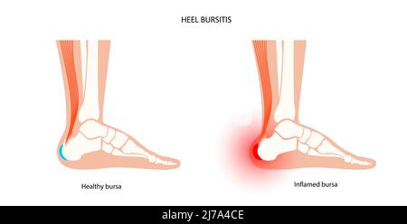 Borsite del tallone, illustrazione concettuale Foto Stock