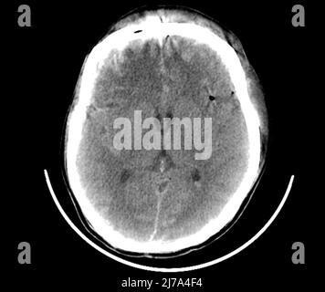 Lesioni cerebrali traumatiche, scansione TC Foto Stock