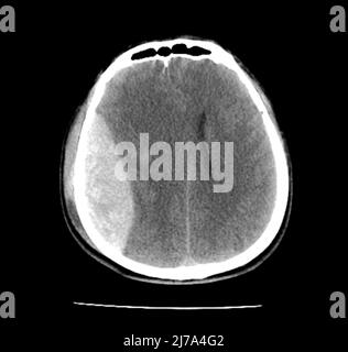 Lesioni cerebrali traumatiche, scansione TC Foto Stock